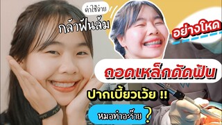 รีวิว ไอซ์ถอดเหล็กดัดฟัน"ปากเบี้ยว"ขั้นตอนพิมพ์ฟัน ใส่รีเทนเนอร์ สยองมาก  ทีเด็ดท้ายคลิป|ikziice💦