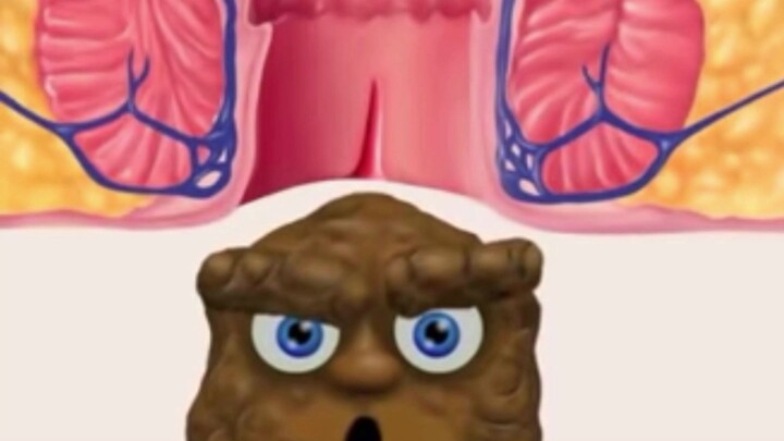 Demonstrasi animasi 3D, penyebab umum fisura anus.