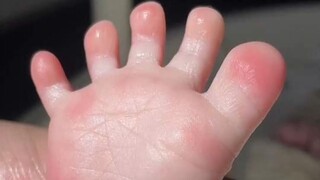 Đôi chân nhỏ xíu của bé cưng thật là vui nhộn! Phản xạ Babinski, lớn lên một chút sẽ biến mất đấy～