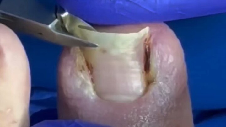 هل تنمو أظافر قدميك إلى داخل الجلد أيضًا؟ تعرّف على الطريقة الصحيحة لتقليم الأظافر!