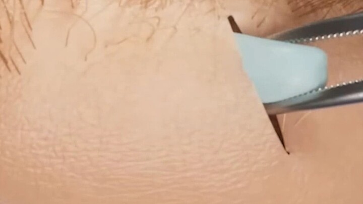 What should I do about a high hairline?