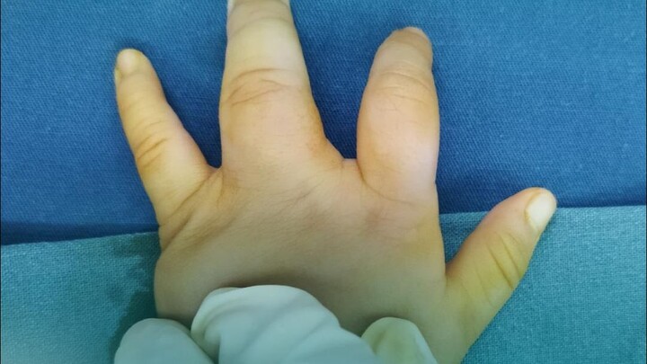 Operasi pemisahan jari “4 jadi 5”, sang ibu: demi anak, ia bahkan mengundurkan diri dari pekerjaanny
