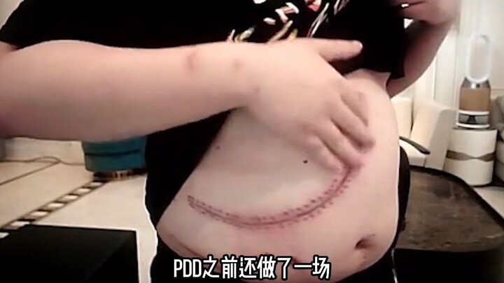 PDD's face twitched after 15 hours of live streaming, suspected of facial paralysis