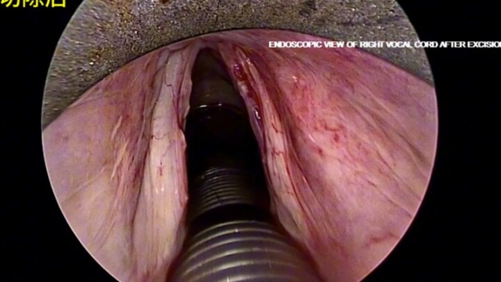 استئصال السلائل الحنجرية