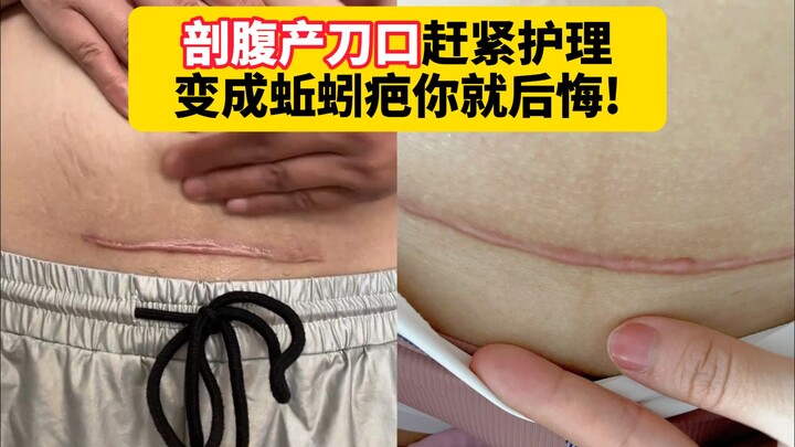 【Sains】Jika perawatan luka bekas operasi caesar tidak dilakukan dengan baik, bekas luka itu bisa ber