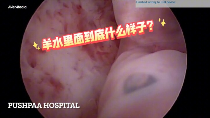 Fetoscopy allows direct visualization of the embryo in amniotic fluid—this is what the birthplace of