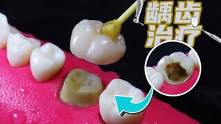 Melihatnya saja sudah terasa sakit, demonstrasi model 6 menit: seluruh proses perawatan saluran akar