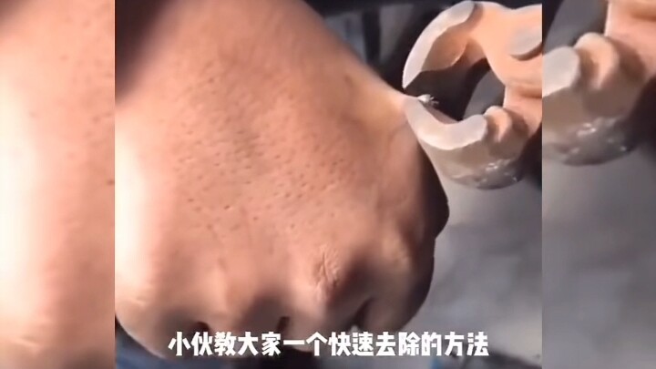 บอกทุกคนถึงวิธีกำจัดหูดอย่างรวดเร็ว