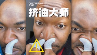 ⚠️⚠️ Kakak ini berhasil memperbaiki kulitnya dengan cara "memeras minyak"!