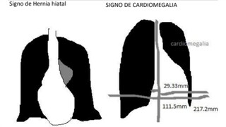 Signos normales del corazón