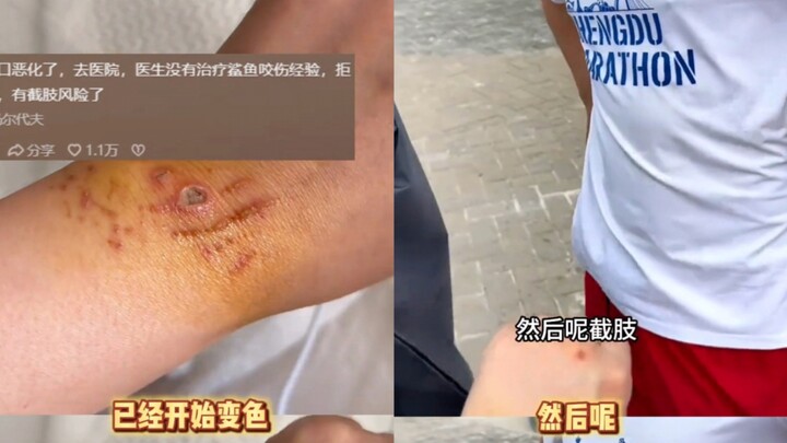 Khi bị cá mập cắn ở Maldives, blogger được nhắc đi khám bác sĩ nhưng phớt lờ; giờ thì tình trạng thự