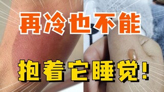 Dù trời có lạnh đến đâu cũng đừng ôm nó khi ngủ, bỏng do nhiệt độ thấp còn nghiêm trọng hơn cả bỏng 