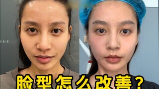 Tidak perlu operasi, memperbaiki bentuk wajah ternyata begitu mudah