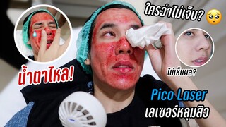 น้ำตาไหล! ใครว่าไม่เจ็บ ทำ Pico Laser ครั้งแรกเอาเรื่อง!! แต่ผลดันเป็นแบบนี้? |  Fararim Story