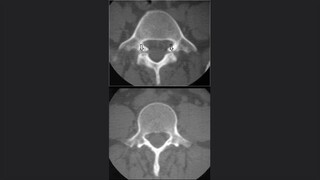 Espondilolisis