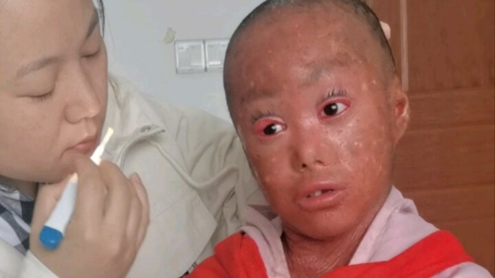 Penyakit sisik ikan ini benar-benar menyebalkan, bahkan saluran telinga pun dipenuhi serpihan kulit.