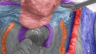 Let's use laparoscopy to explore the organs inside your belly—can you handle it?