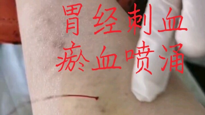 Practical point-pricking on the Foot Yangming Stomach Meridian: Stagnant blood gushes out.