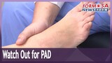 Doctors warn of PAD, or compromised blood supply to the feet