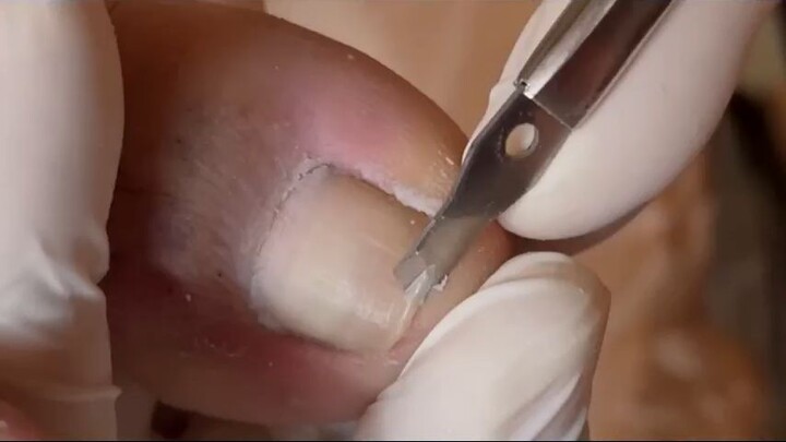 Man, that Toenail Was deep!!! - Copy_R