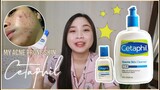 CETAPHIL Gentle Skin Cleanser Review || Maganda ba sa acne prone skin? 🤔