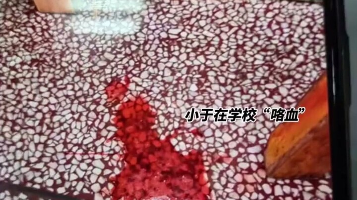 Remaja berusia 13 tahun di Changsha mengalami “batuk darah intermiten” selama 4 bulan! Saat berhadap