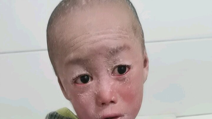 ฤดูกาลเริ่มหนาว ร่างกายเริ่มมีสะเก็ดผิวหนังมากขึ้น ทุกวันต้องแช่ยาและกำจัดเซลล์ผิวที่ตายแล้ว เมิงเมิ