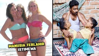 Lengket Tak Terpisahkan! Inilah 7 Manusia Kembar Paling Poluer di Dunia yang Memprihatinkan
