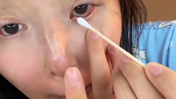 Quy trình trước khi ngủ của một cô gái mắc hội chứng Stevens-Johnson