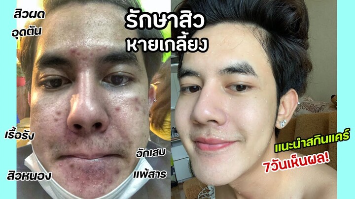 แชร์ประสบการณ์หน้าสิว10ปี สิวเห่อจนหน้าพัง!! ทำไงให้กลับมาเนียนกริบ หน้าใสเกิน!  l Fararim Story