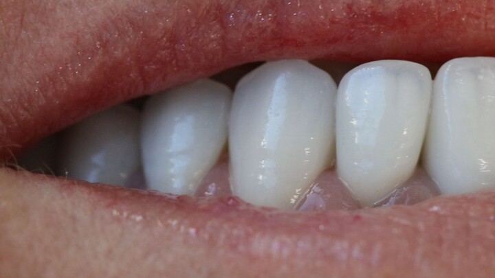 Lente de contato dental