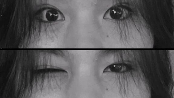 eye block