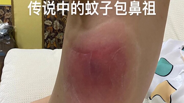 Gila! Wanita Digigit Nyamuk Sebesar Mulut Mangkuk, Ternyata Biaya Pengobatannya Capai Ribuan Yuan!