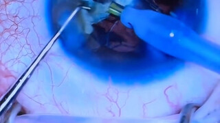 The process of cataract surgery—watching as those cloudy substances inside were gradually suctioned 