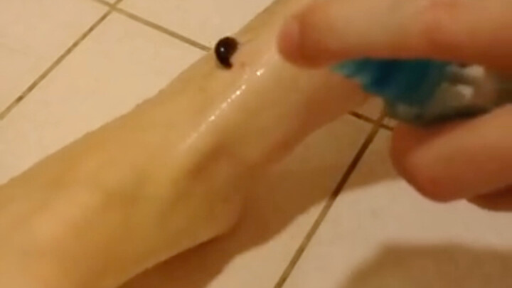 被蚂蝗咬了不要慌，现场演示正确的拔除方法