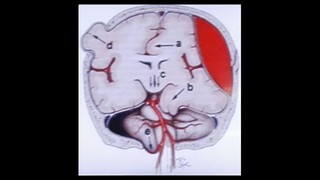 La clasificación de los hematomas