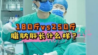 Seperti apa sih bentuk hati berlemak dengan berat 90 kg dan 125 kg