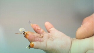 Bagaimana rasanya mencabut 3 jarum Kirschner sekaligus, Ibu: Dia tidak sakit, yang sakit aku