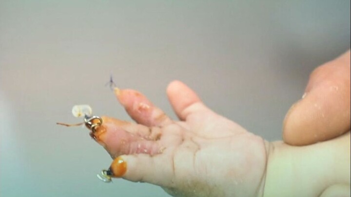 一次拔3根克氏针是什么体验，妈妈：她不疼我疼