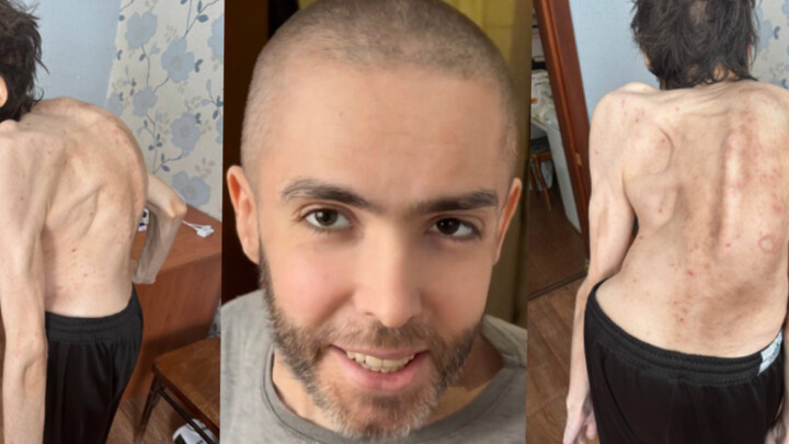 Helping a Poor Person with Spinal Curvature in Russia (4)