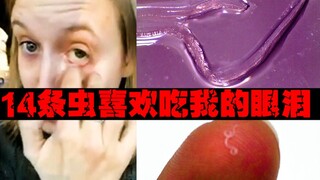 [Monsters in the Eyes] Her eyes were invaded by 14 worms. What did she go through?