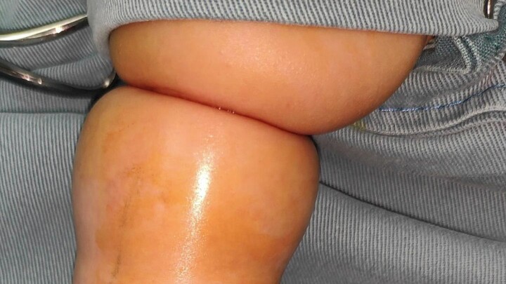 Kaki kanan bayi seolah-olah terikat oleh “kawat baja”, setelah menjalani operasi selama 2 bulan, bet