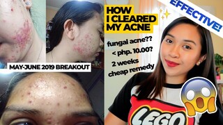 ETO NA ANG TOTOONG SOLUSYON SA MGA SUMPA SA MUKHA! (mura at mabilisang pagtanggal ng mga pimples)