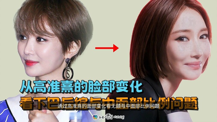 从高准熹的面部变化看无颌与中面部比例问题-海云台矫正牙科带你了解无颌、老化，以及重塑和谐上下颌牙列的 S&S 矫正