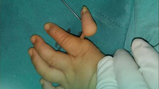 这样的手指也能接上?填骨头转肌腱重建漂浮拇指