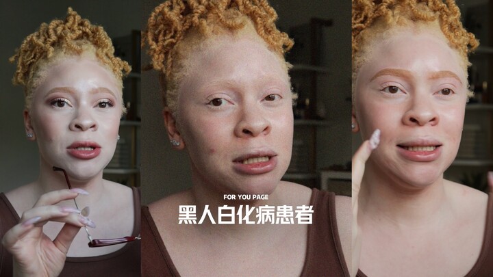 Một số câu hỏi ngớ ngẩn mà bệnh nhân bạch tạng da đen thường xuyên được hỏi