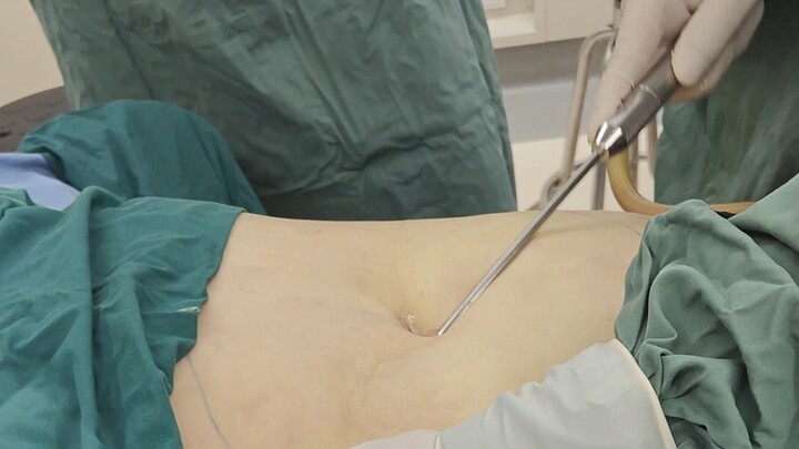 The abdominal liposuction procedure was performed by Professor Zhao Qiming, President of the Zhejian