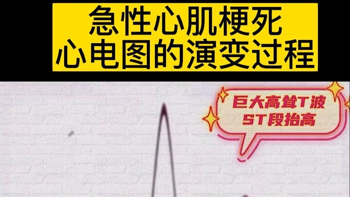 Perkembangan Pola EKG pada Infark Miokard