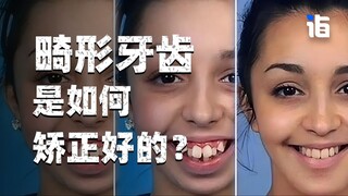 How exactly are crooked teeth corrected?