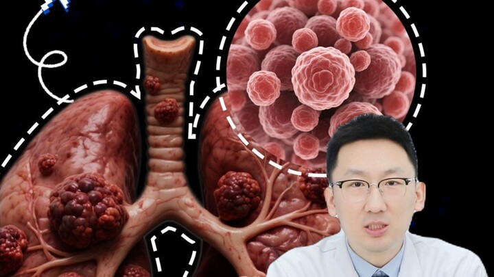 Tidak merokok pun bisa terkena kanker paru-paru❗️ Penyebab kematian akibat kanker nomor satu di selu